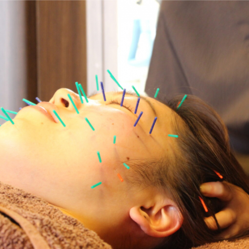 美容鍼コース(2回目・回数券使用)