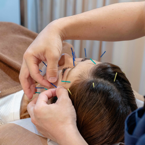 継続施術の方・美容鍼